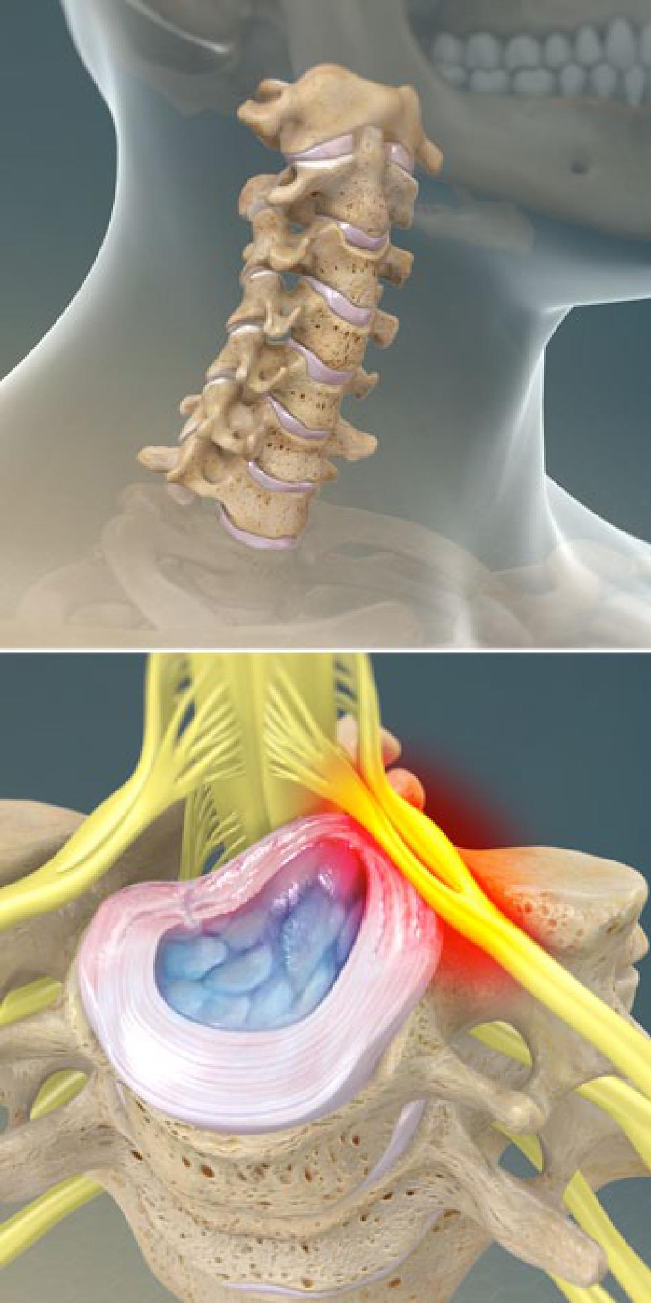 Neck Pain Dr Justin Ledesma